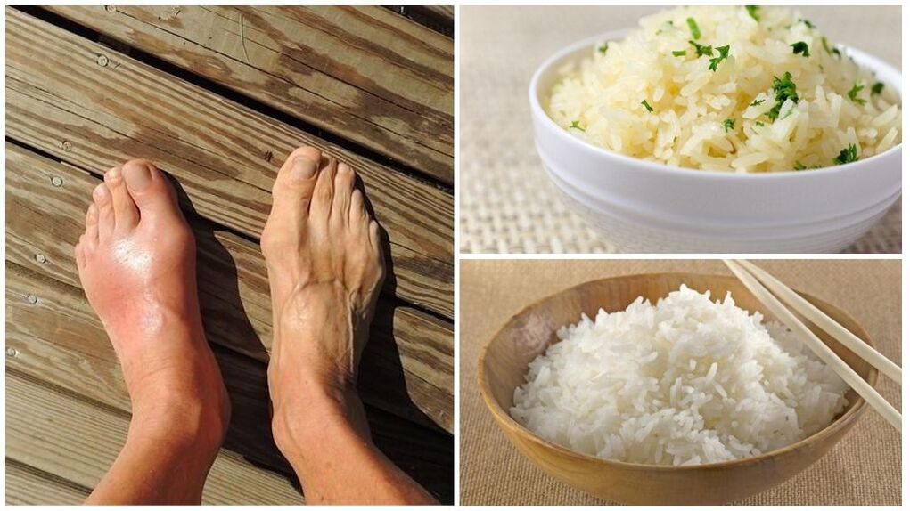 رژیم غذایی مبتنی بر برنج برای بیماران نقرس توصیه می شود. 